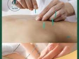 Cấy chỉ sâm protein: Giải pháp tối ưu cho lưu thông mạch máu và bổ thần kinh