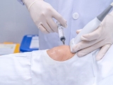 Tiêm chất nhờn cho khớp