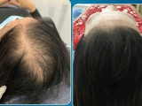Sử dụng công nghệ cao tiên tiến của Pháp: Phun sương nano phục hồi tóc hiệu quả