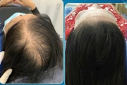Sử dụng công nghệ cao tiên tiến của Pháp: Phun sương nano phục hồi tóc hiệu quả