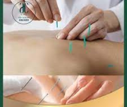  Cấy chỉ sâm protein: Giải pháp tối ưu cho lưu thông mạch máu và bổ thần kinh