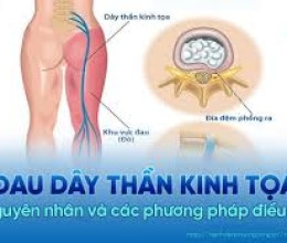 Nguyên nhân và Phương pháp điều trị đau thần kinh tọa 