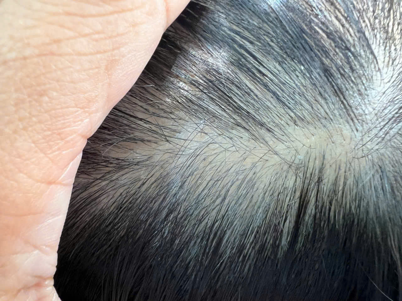 Chuyên chữa rụng tóc hói đầu bình dương nhé